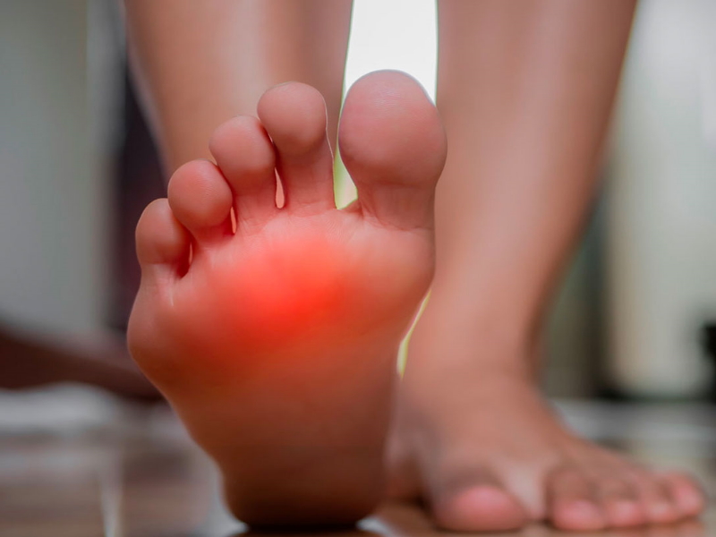 Neuroma de Morton